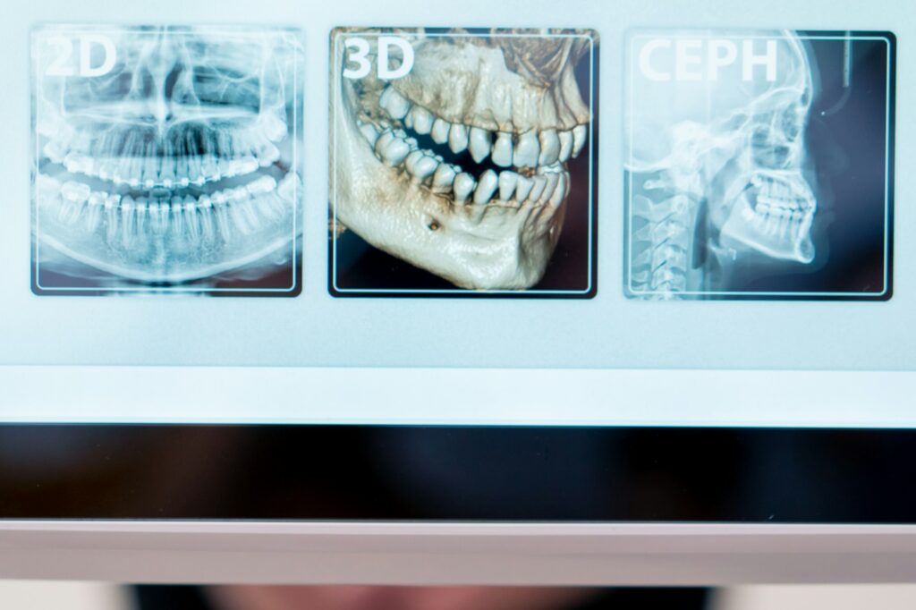 close-up 3D shot of a scan of the jaw of the oral cavity and head on a screen in clinic