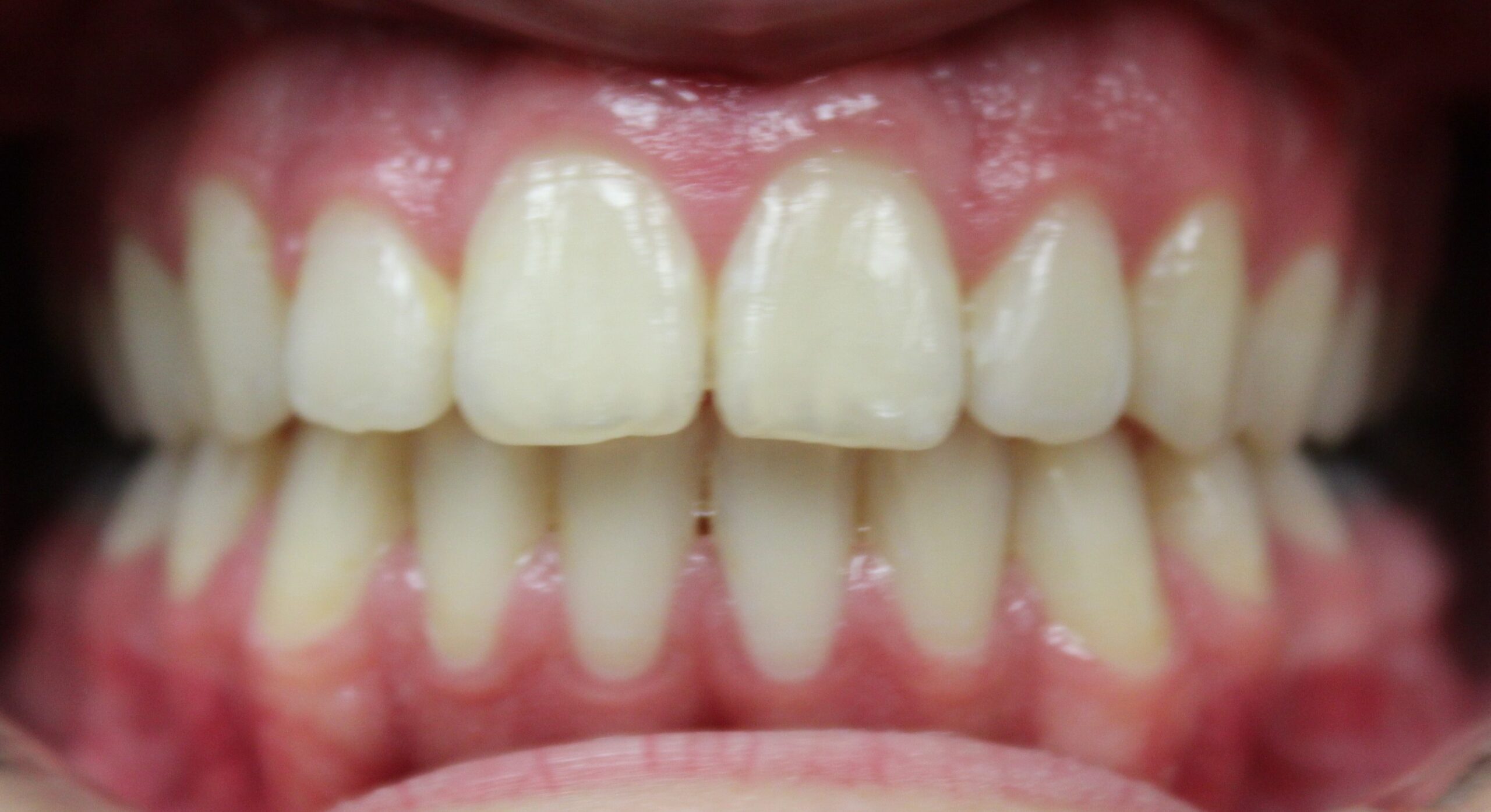 Corrective jaw surgery B after 2